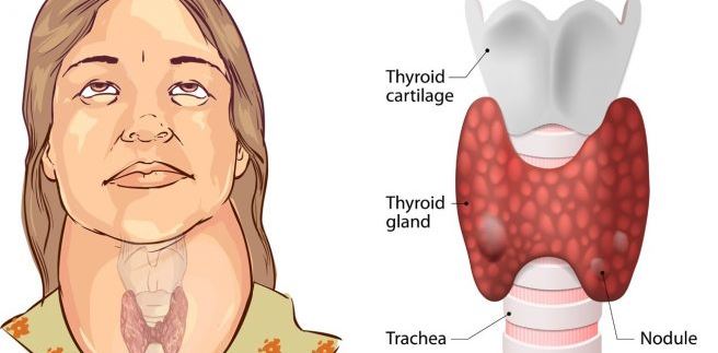 थाइराइड र यसकाे लक्षणहरू